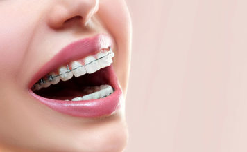 Fakty i mity na temat aparatu ortodontycznego