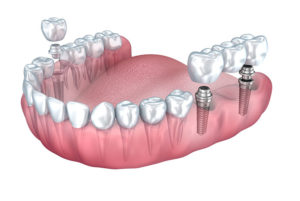 Czym są implanty zębowe i czy warto?